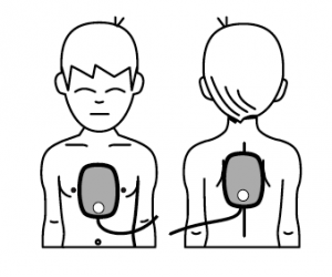 Platzierung AED-Kinderelektroden